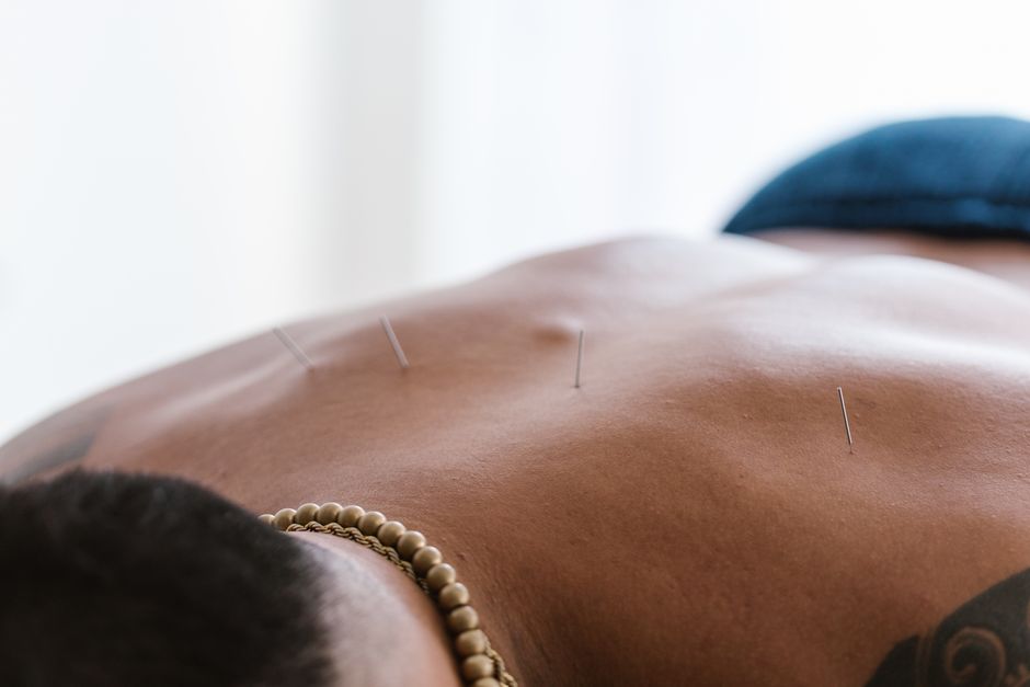 Acupuncture needles placed during a traditional Korean Medicine session in Korea