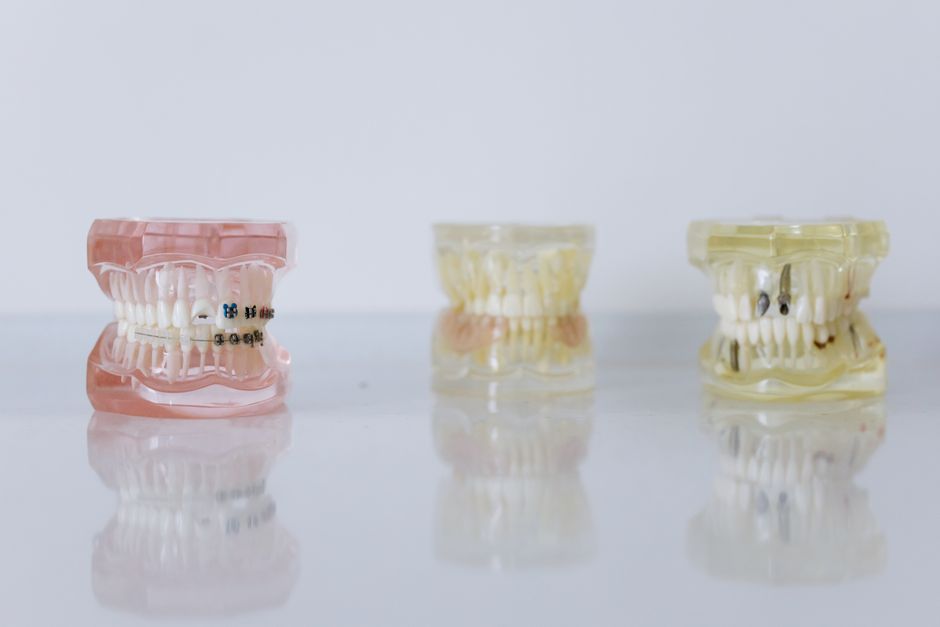 Patient recovery after jaw surgery showing improved facial profile and bite alignment result