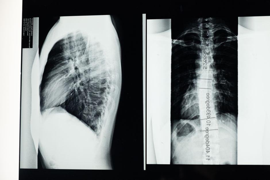 Scoliosis Correction Surgery procedure - Patient consultation at KAHF-accredited hospital in Seoul, South Korea