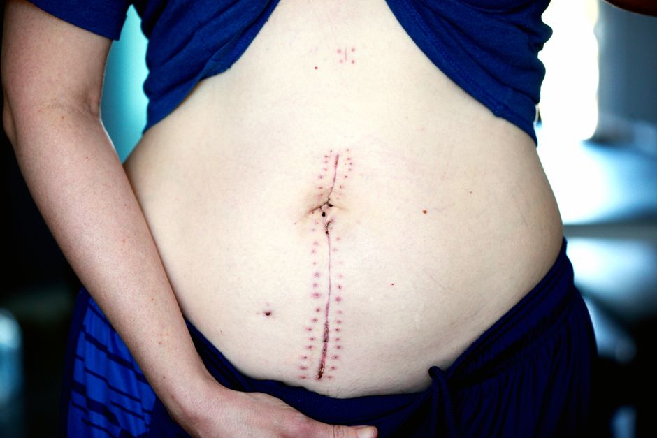 Tummy Tuck procedure - Patient consultation at KAHF-accredited hospital in Seoul, South Korea